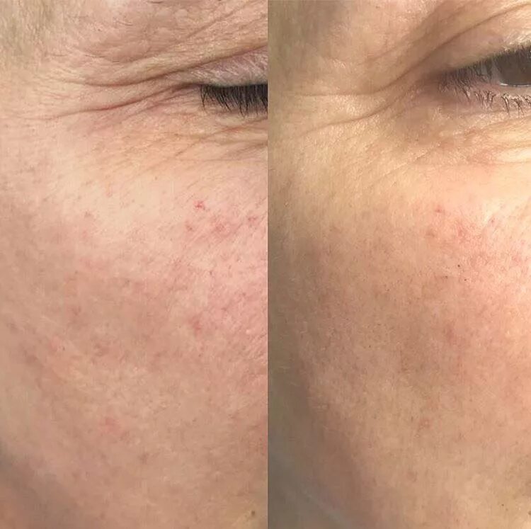 лазерный карбоновый пилинг лица отзывы. карбоновый пилинг с лазерной шлифовкой что такое. маска для карбонового пилинга. лазерный карбоновый пилинг лица. лазерный карбоновый пилинг.