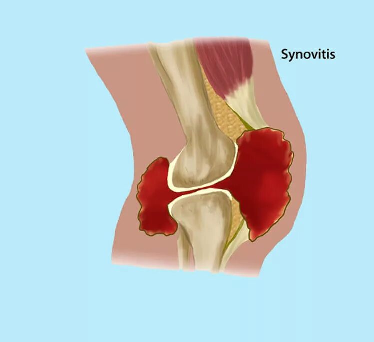 Кровотечение в коленный сустав. Синовит синовиальная оболочка. Гемартроз тазобедренного сустава. Синовит коленного сустава.
