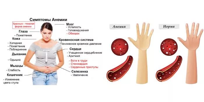Анемия стоп. Дефицит железа. Дефицит железа в организме. Внешние проявления анемии. Дефицит железа в организме симптомы.
