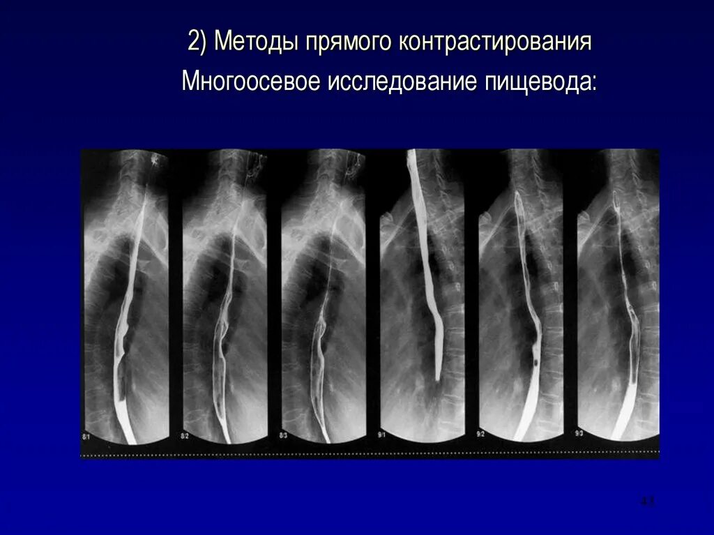 Пищевода с барием. Контрастирование пищевода рентген. Рентген пищевода (эзофагография). Контрастирование пищевода барием. Фаза двойного контрастирования пищевода.