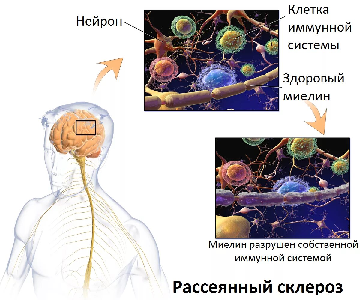 Рассеянный склероз. Ранняя стадия склероза. Multiple Sclerosis. Иммунные клетки мозга