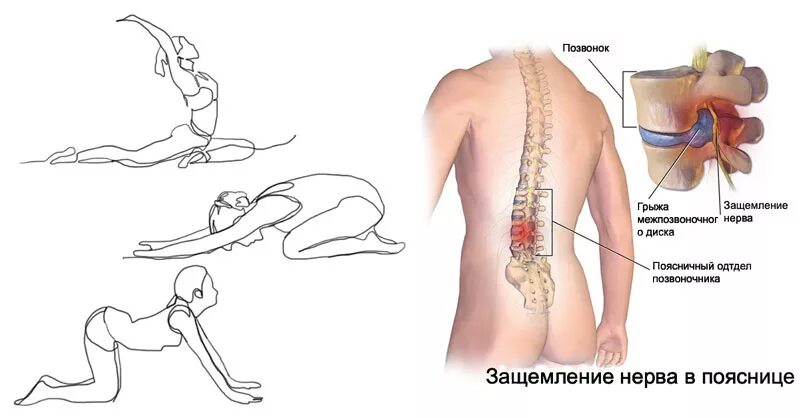 Зажата поясница