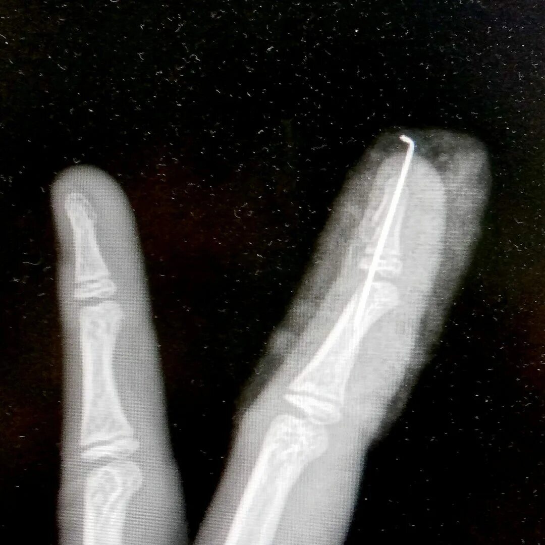 перелом фаланги большого пальца на руке