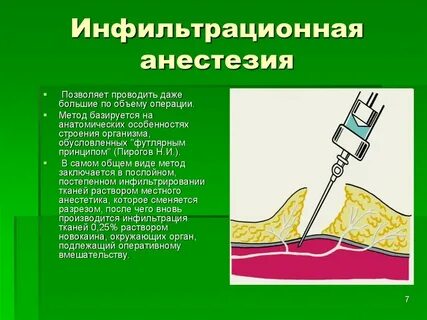 Инфильтрационная анестезия