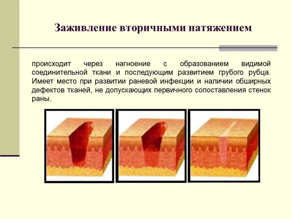 Через сколько заживает рана. Заживление РАН хирургия вторичная натяжение. Заживление РАН первичным натяжением. Первичное и вторичное натяжение заживление РАН. Заживление РАН первичным натяжением этапы.