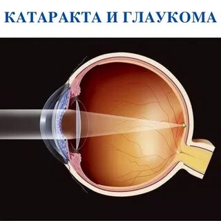 Близорукость глазное яблоко