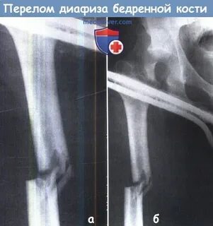 Диафиз бедренной кости