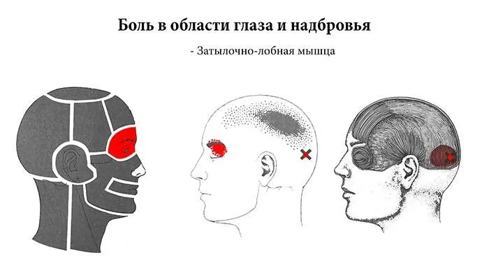 Боль в затылке. Головная боль локализация. Боль в затылке головы. Болит висок и затылок с левой стороны. Боли в правой височной области