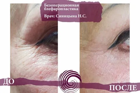 Безоперационная блефаропластика отзывы