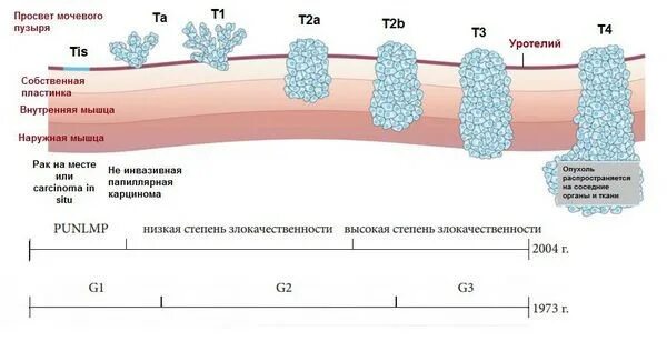 G1 опухоли. Опухоль мочевого пузыря в стадии т3:. Размер опухоли мочевого пузыря по стадиям. Типы роста опухоли мочевого пузыря. Опухоль мочевого пузыря классификация ТНМ.