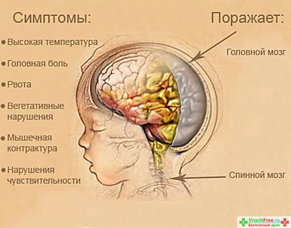 Инфекционные поражения мозга. Воспаление головного мозга симптомы менингит. Воспаление оболочек головного мозга. Серозный туберкулёзный менингит. Оболочка головного мозга менингит.