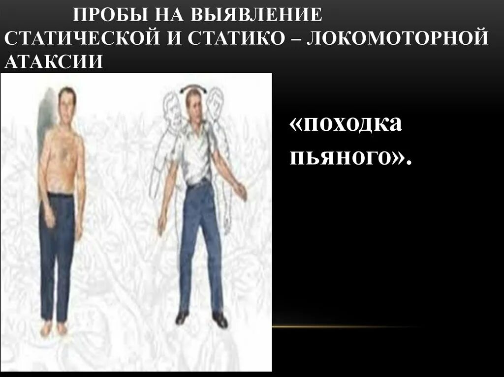 Статическая и динамическая атаксия. Статико-динамическая атаксия. статическая атаксия пробы. выявление статико-локомоторной атаксии. статико локомоторная атаксия пробы.