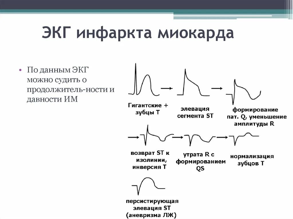 ЭКГ снимки инфаркта миокарда. Описание ЭКГ при инфаркте миокарда. Выявление на ЭКГ инфаркта миокарда. Снимок ЭКГ при инфаркте миокарда.