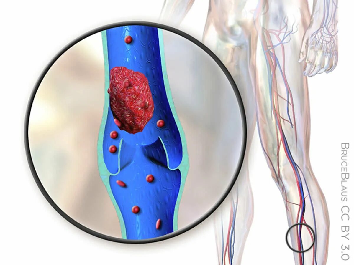 Тромбы в сосудах причины
