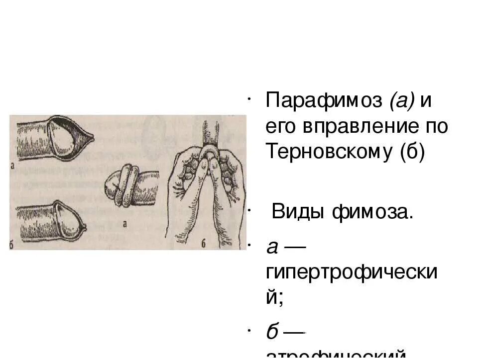 У ребенка под крайней плотью. Строение крайней плоти. фимоз и парафимоз у детей. парафимоз вправление головки.
