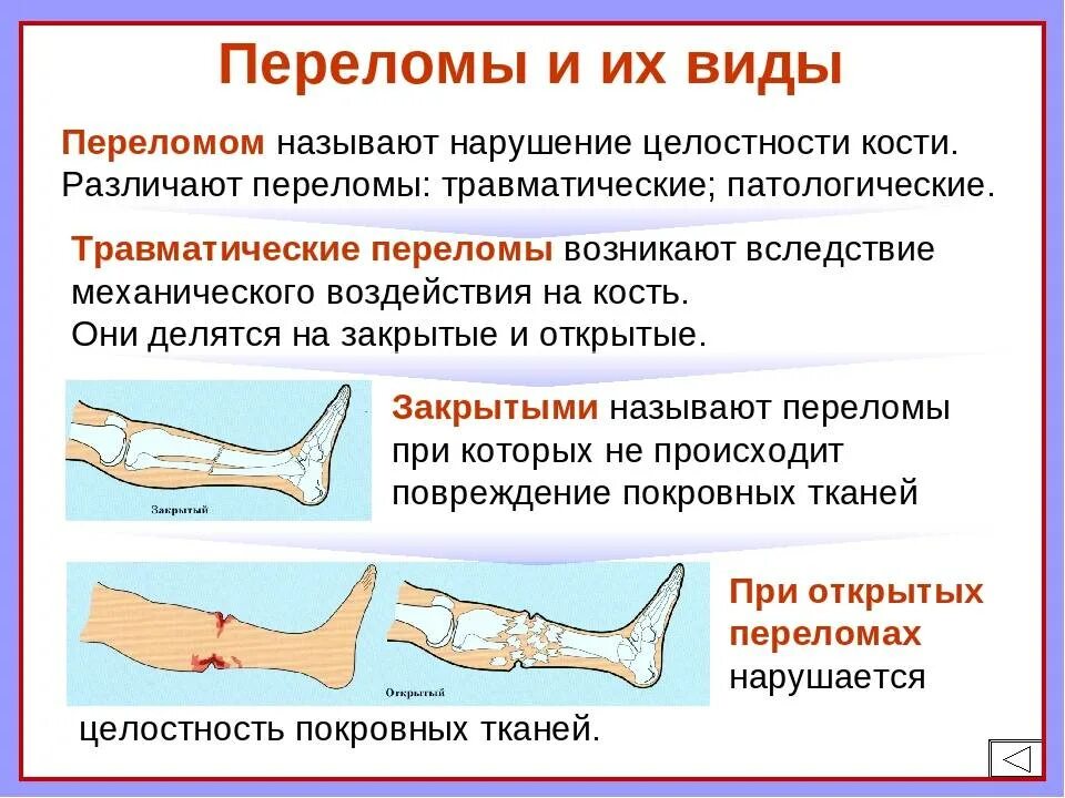 Трещина в организме. Переломы костей виды признаки первая помощь. Классификация переломов костей конечностей. Перелом характеристика и первая помощь. Классификация переломов по характеру повреждения кости.