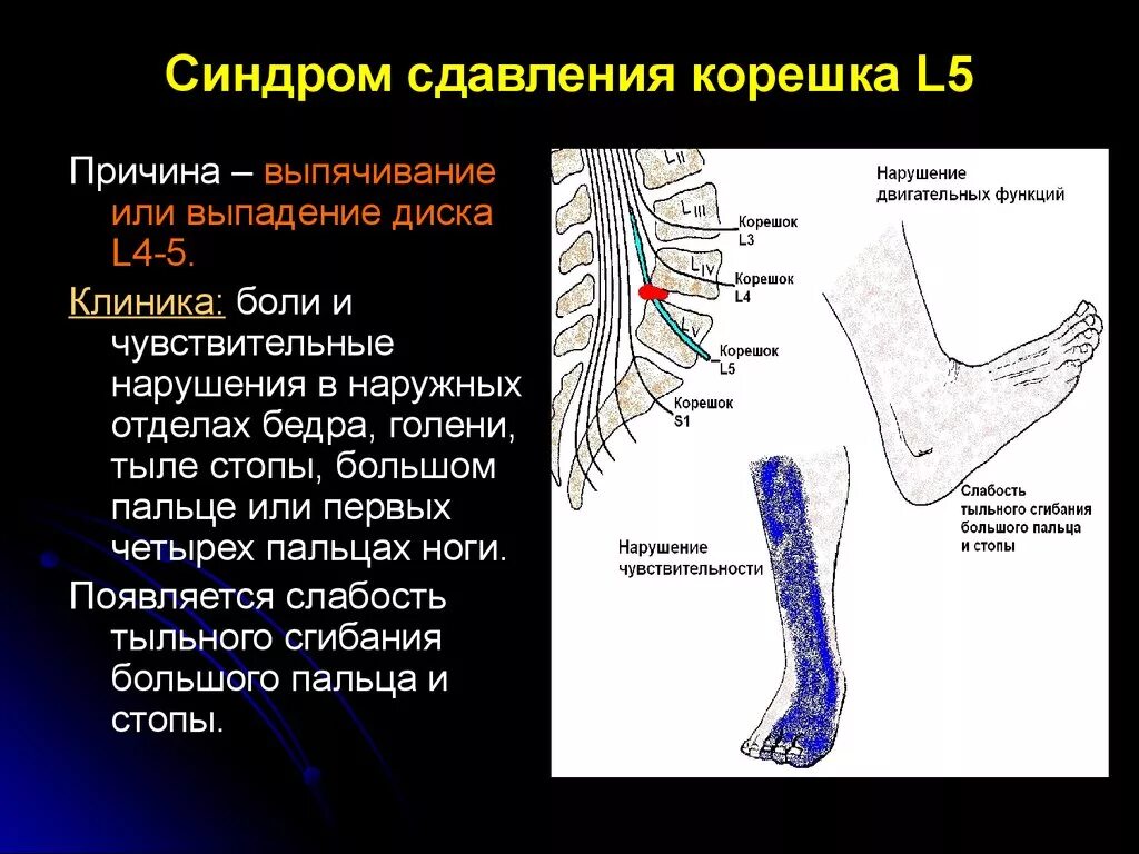 Поражение корешковых нервов. Синдром сдавливания корешка l5. Синдром компрессии корешка l5. Компрессия корешка s1. Компрессия Корешков l5 s1.