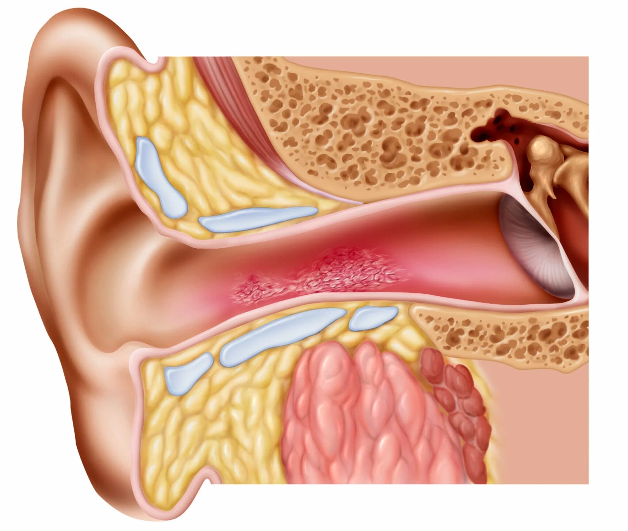 Почему воспаление среднего уха. Золотистый стафилококк отит.