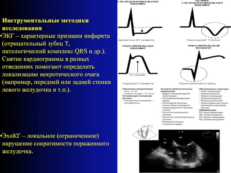Отрицательный зубец т на экг в v1 v2. Зубец р в v1 в норме. Зубец p на экг в v1 отведении. Отрицательные зубцы на экг. Отрицательные зубцы т на экг в v2 v5.
