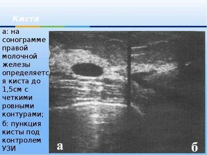Чем отличается киста