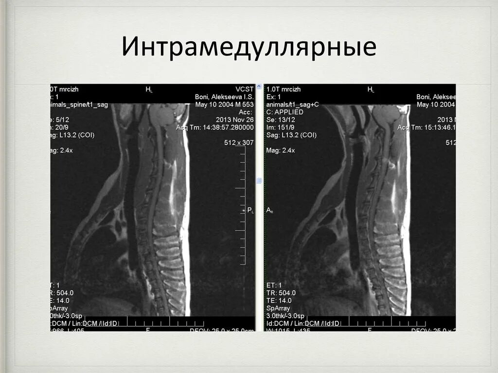 Интрамедуллярная опухоль спинного мозга. Интрамедуллярная опухоль спинного мозга мрт. Интрамедуллярное объемное образование. Интрамедуллярные очаги. Интрамедуллярные опухоли спинного