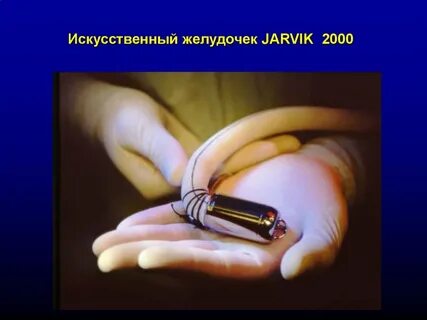 Первый в мире искусственный желудочек для сердца