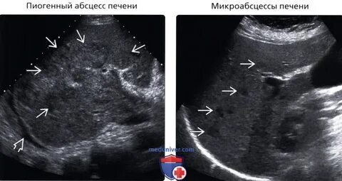 Образования в печени на узи
