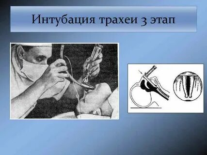 Интубирование что это такое простыми словами