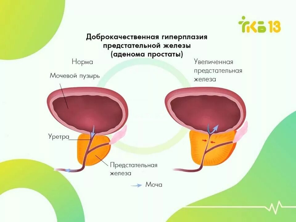 Остаток мочи у мужчин. Ультразвуковое исследование предстательной железы и мочевого пузыря. УЗИ мочевого пузыря у мужчин и предстательной железы. Ультразвуковое обследование предстательной железы и мочевого пузыря. Мочевой пузырь и предстательная железа.