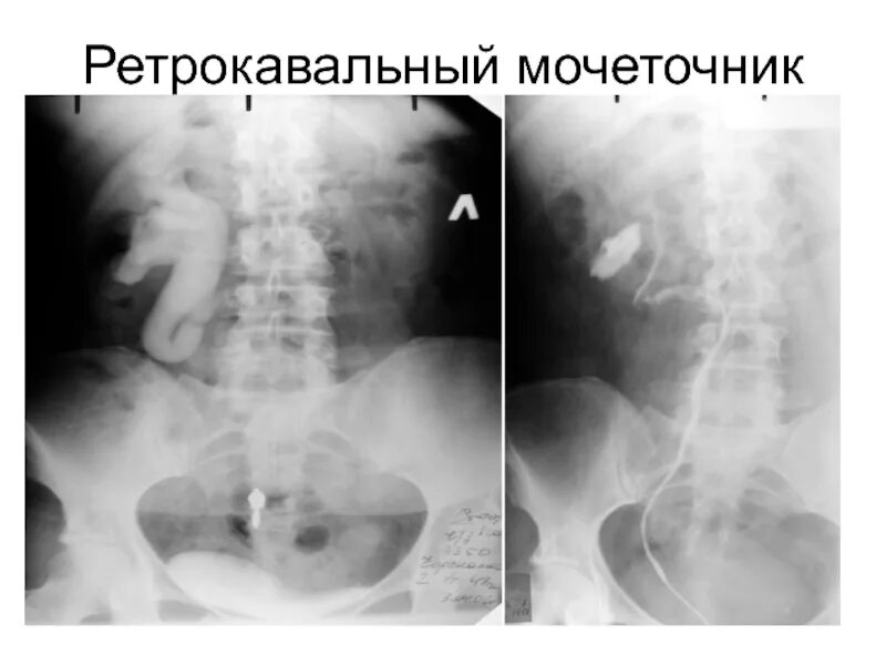 Перегиб мочеточника. Ретрокавальный мочеточник на рентгене. Ретрокавальное расположение мочеточника. Ретрокавальный и ретроилиакальный мочеточник. Мочеточник ретрокавальный на кт.