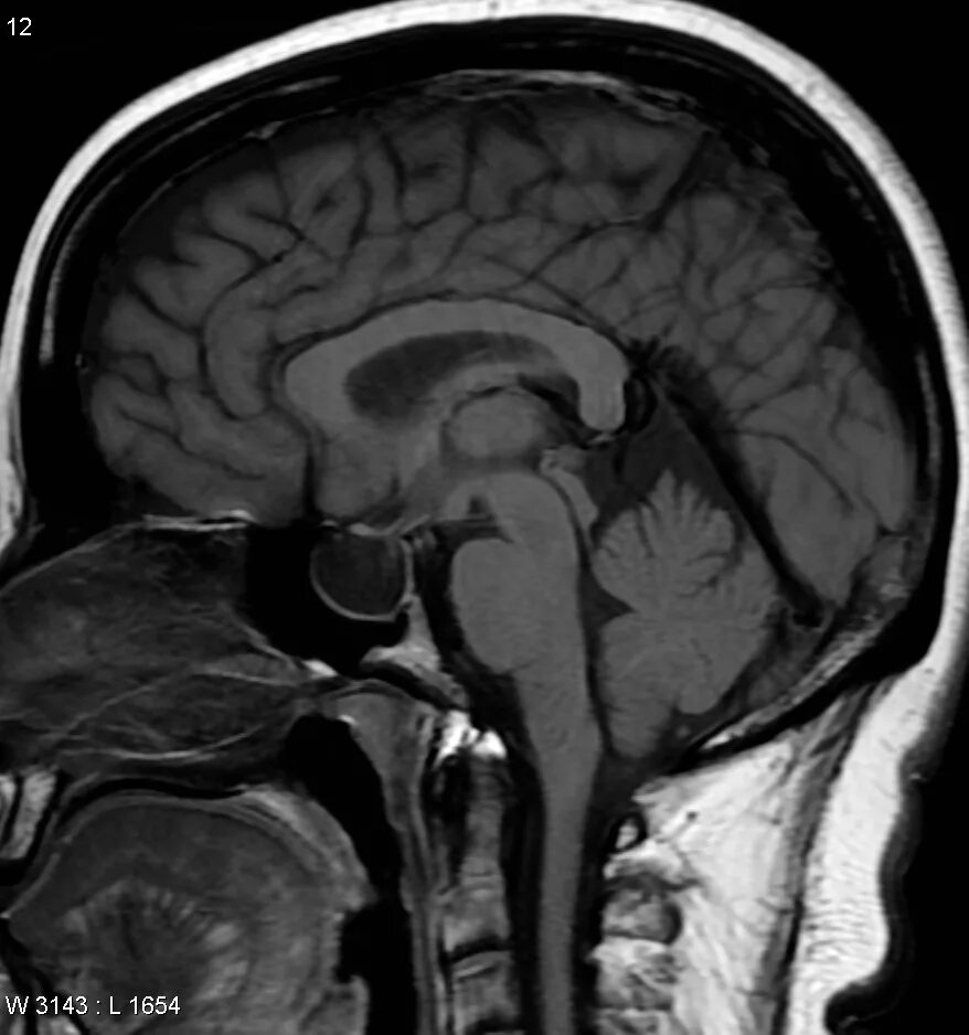 Мирена мрт. Empty sella mri. внутричерепная гипертензия на кт. внутричерепная гипотензия мрт. арахноидальная киста пинеальной области.
