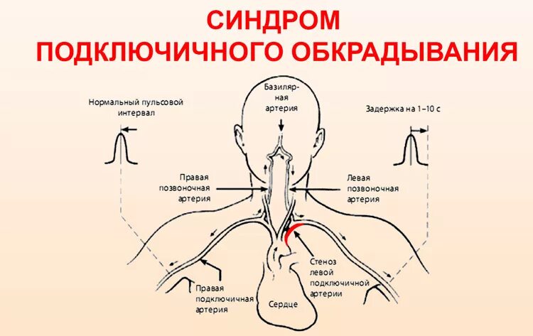 Синдром подключичного обкрадывания. Обкрадывания подключичной артерии. Синдром обкрадывания подключичной артерии. Синдром подключично позвоночного обкрадывания.