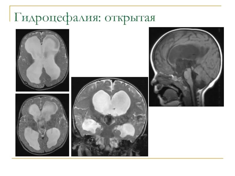 Выраженная заместительная гидроцефалия. Арезорбтивная гидроцефалия головного мозга. Внутренняя открытая гидроцефалия головного мозга у взрослых что это. Наружная гидроцефалия головного мозга мрт. Наружная и внутренняя гидроцефалия головного мозга.