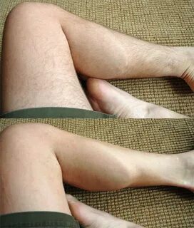 Dark leg