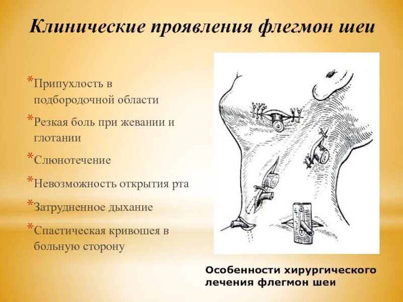 Клинические симптомы флегмоны. Общие симптомы флегмона.