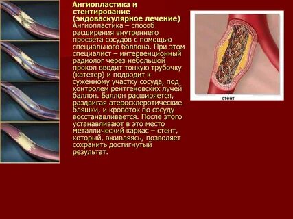 Отзывы после стентирования