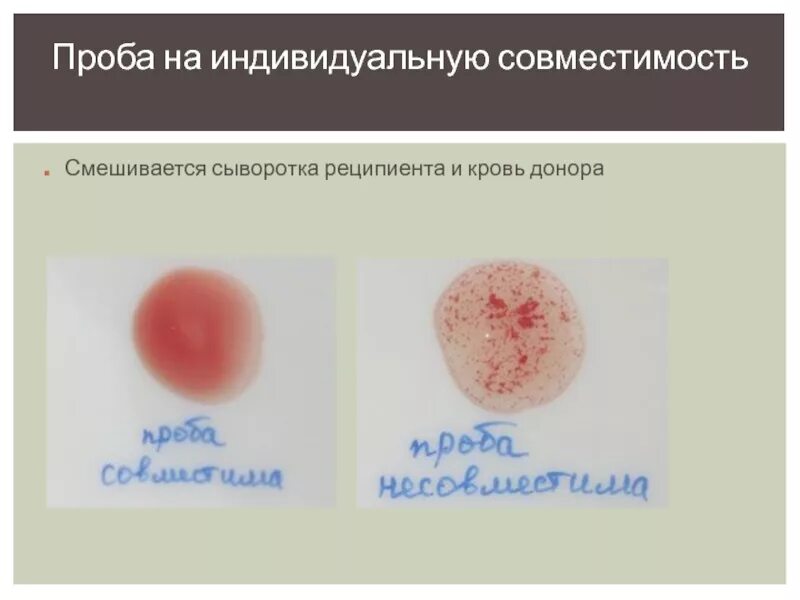 Проба на индивидуальную совместимость. Проба на совместимость крови донора и реципиента. Проба на индивидуальную совместимость крови. Проведение проб на индивидуальную совместимость крови.