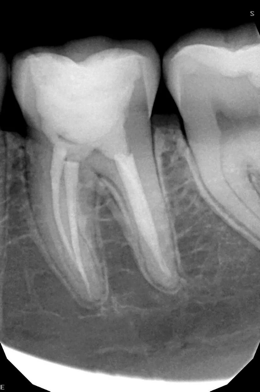 Канал трещин. Трещины на зубах вертикальные.