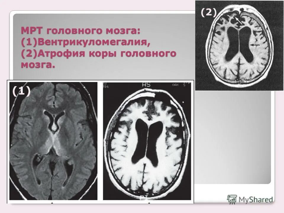 Корковые изменения головного мозга. Вентрикуломегалия головного мозга у ребенка. Вентрикуломегалия боковых желудочков. Правосторонняя вентрикуломегалия. Вентрикулоасимметрия головного мозга.