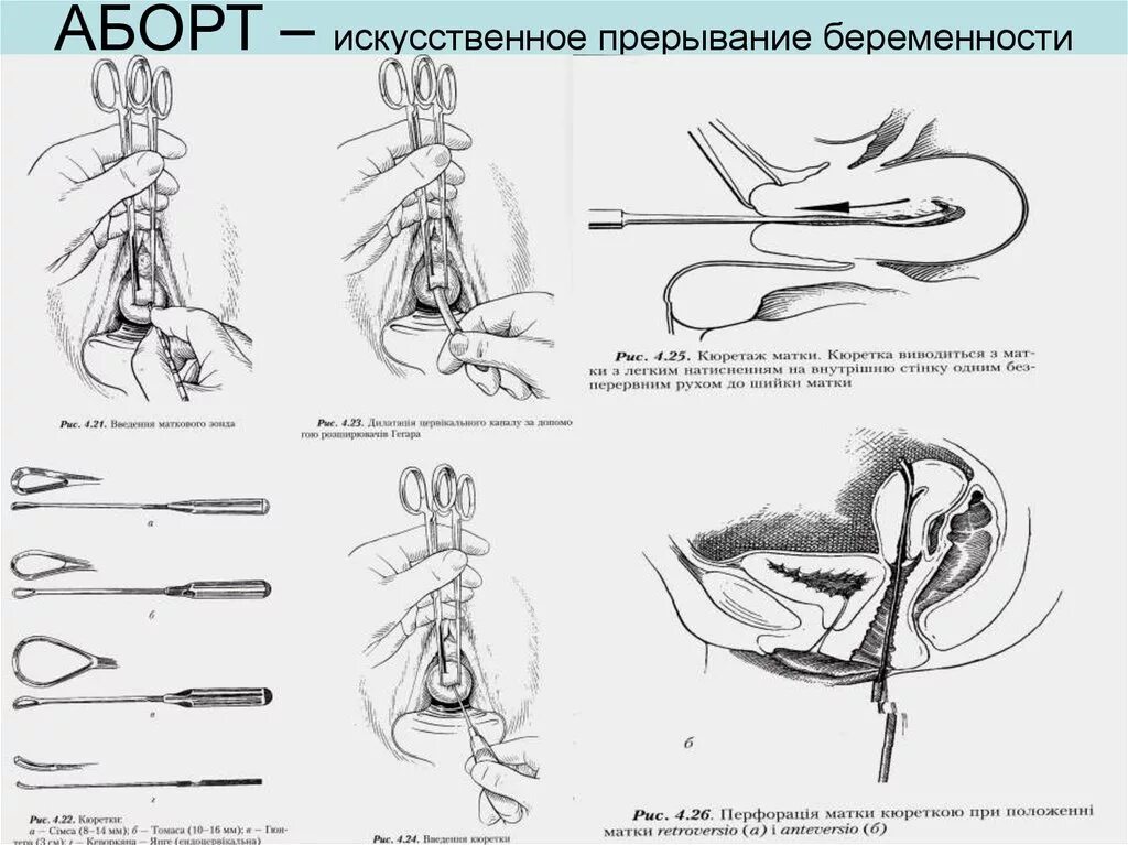 Сколько времени делают оборот. Искусственный аборт схема. Схема хирургического аборта. Искусственное прерывание беременности. Хирургический искусственный аборт.