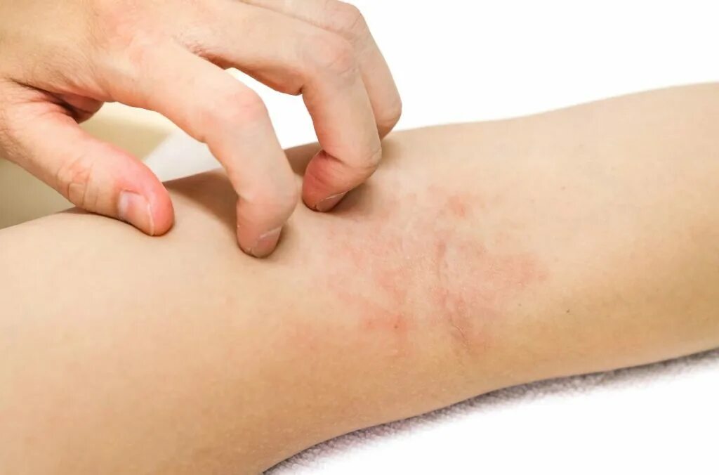 Xenopsylla cheopis самец. Xenopsylla cheopis. блоха pulex irritans самец. бубонная чума возбудитель. блоха возбудитель.