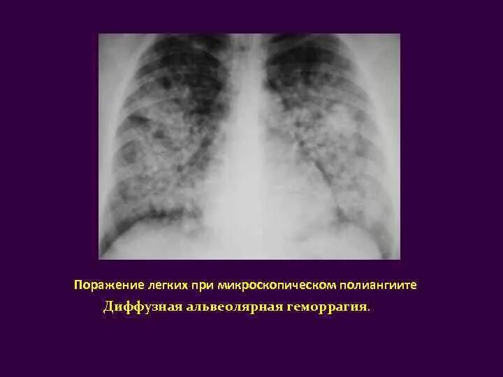 Поражен легких 3. Микроскопический полиангиит. Диффузная альвеолярная геморрагия.