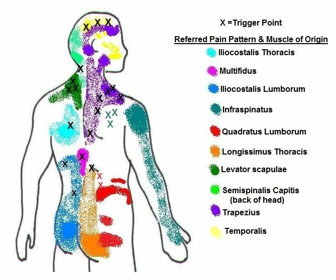Pt referrer. Триггерные точки. Fibromyagia, pain points, diagnostic. Trigger point pain patterns. Миофасциальные триггерные точки шеи.