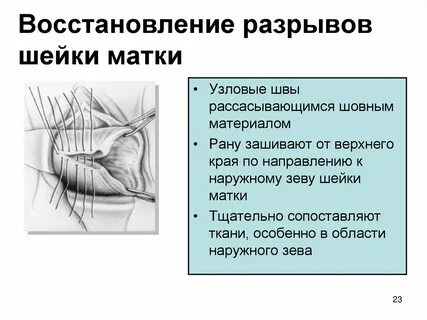 Восстановление разрывов