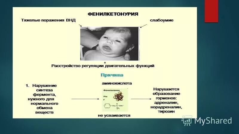 Фенилкетонурия фермент. Фенилкетонурия кариотип. Кариотип при фенилкетонурии. Фенилкетонурия кариотип формула. Симптомы фенилкетонурии у детей.