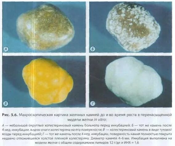 Растворение камней в желчном пузыре отзывы. Разновидность камней в желчном пузыре. Исследования камней в желчном пузыре. Форма камней желчного пузыря.