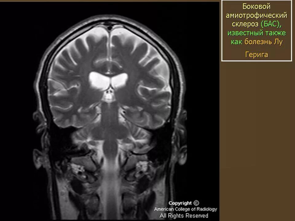 Боковой амиотрофический склероз причины заболевания. Амиотрофический латеральный склероз. Боковой амиотрофический склероз. Мозг на мрт при боковом амиотрофическом склерозе. Боковой амиотрофический склероз мрт мозга.