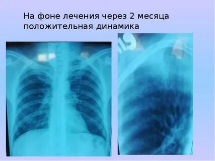 Туберкулез положительный