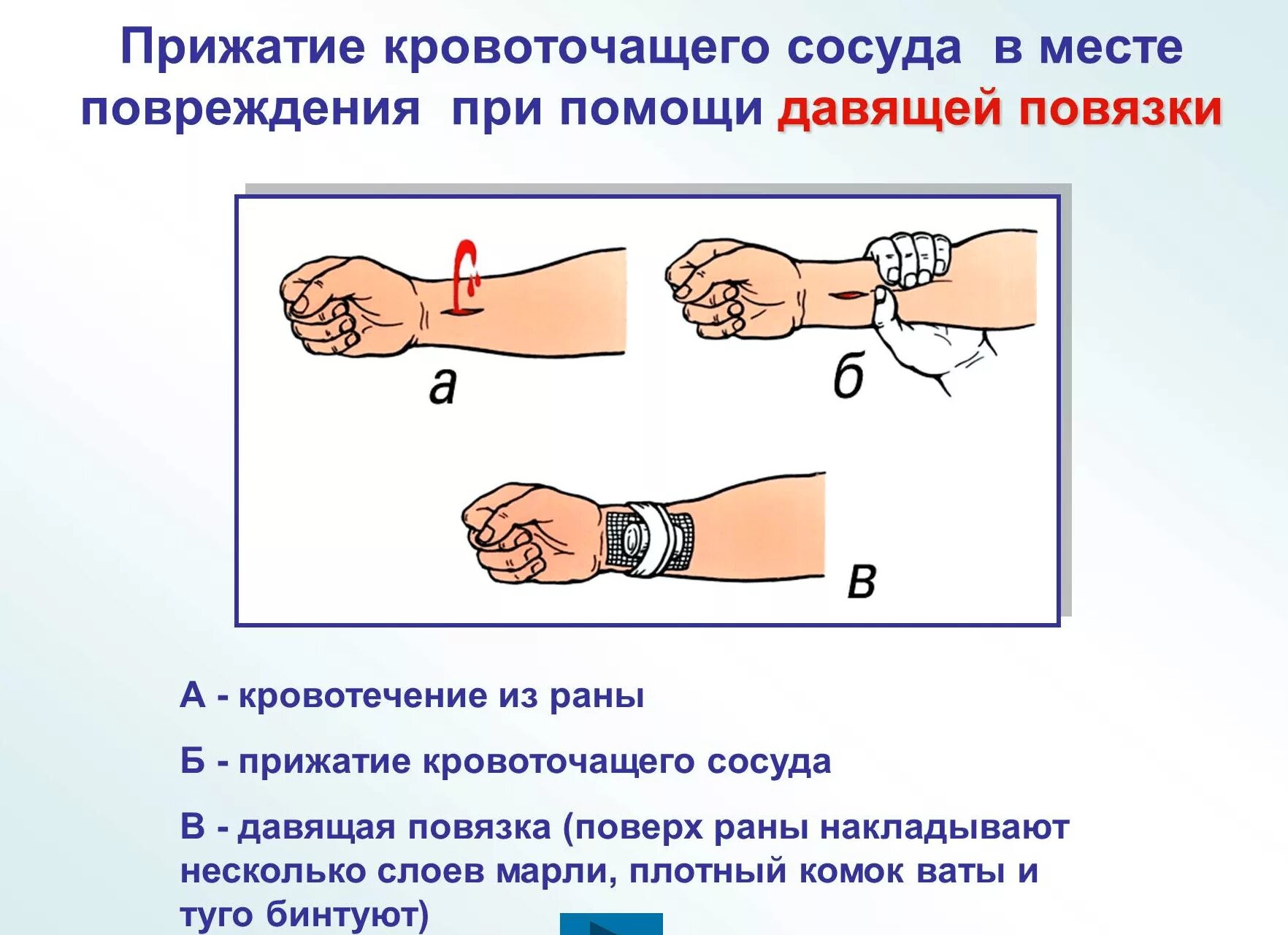 Первая помощь при ранении наложение давящей повязки. Давящая повязка при кровотечении накладывается. Наложить давящую повязку для остановки кровотечения. Наложение давящей повязки закрутки. Способы временной остановки кровотечения наложение давящей повязки