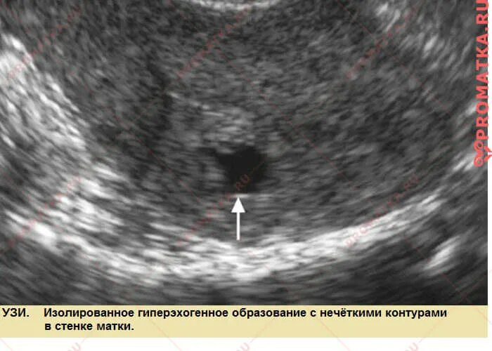 образование в матке на узи